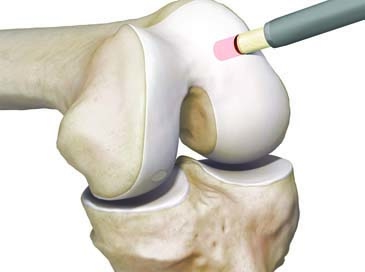 orthopädie-kassel-kniegelenksoperationen-arthrose-Knorpelknochenzylindertransplantation